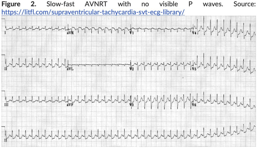 Figure 2 Fast-slow AVNRT with no visible P waves.